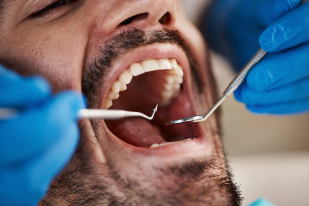 Best Emergency Dentist for Lost Fillings or Crowns in West Vero Corridor, FL