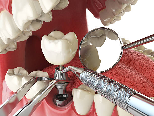Best Broken or Cracked Tooth Emergency Dentist in West Vero Corridor, FL